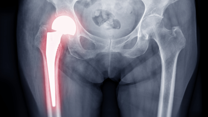 fracture_hanche_NL_avril2026